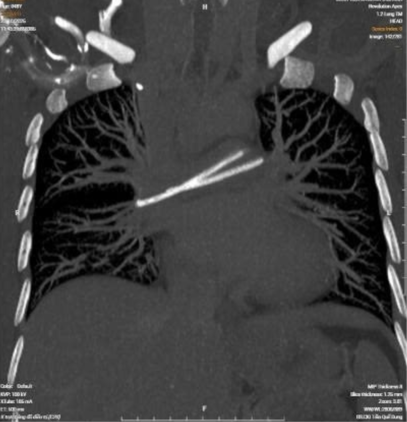 Ống truyền hóa chất bị đứt âm thầm trôi vào tim